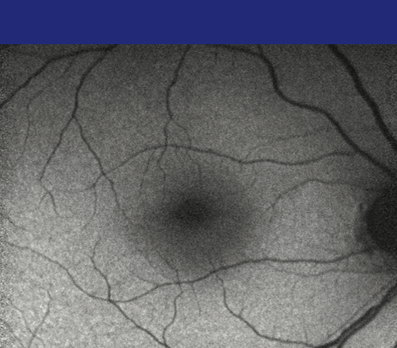 Normal Retina<sup>†</sup>